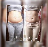 لاغری با کرایولیپولیز در کلینیک آسایش
