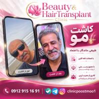 کاشت مو و ابرو اقساطی