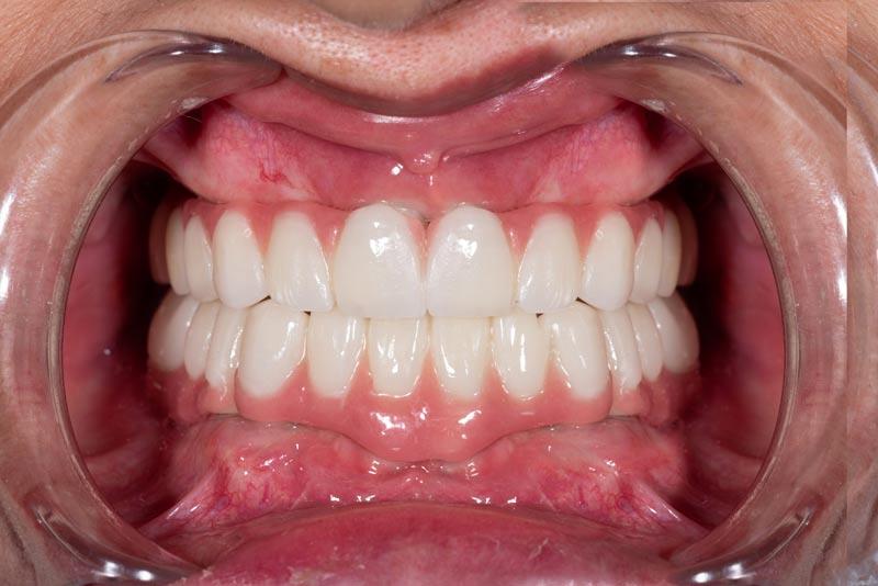 ایمپلنت دندان و کامپوزیت دندان، لمینت سرامیکی